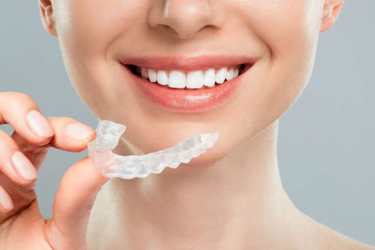 Invisible Aligners