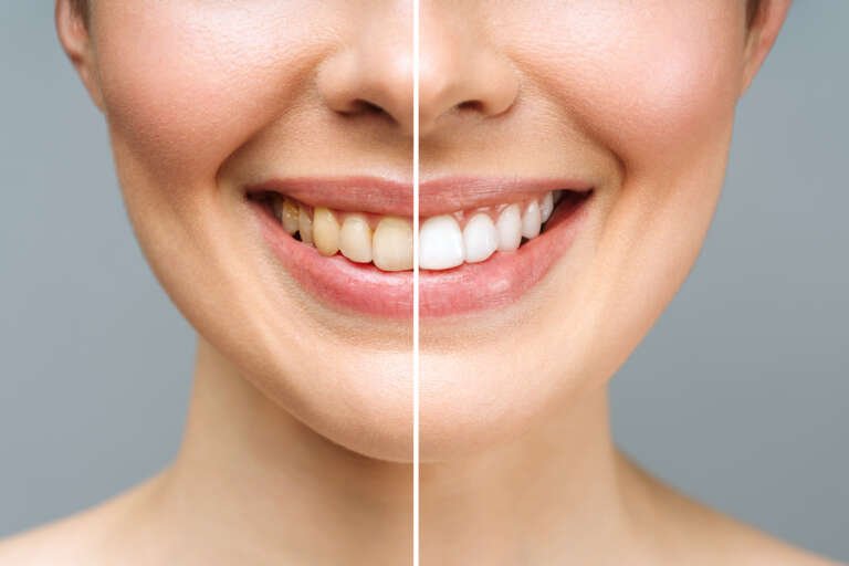 Teeth Whitening